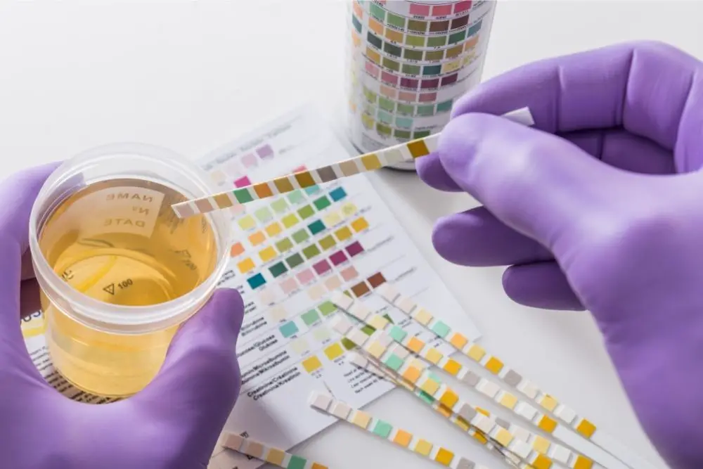 How Long Does LabCorp Take For Urine Results?


